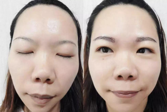 植眉毛效果图
