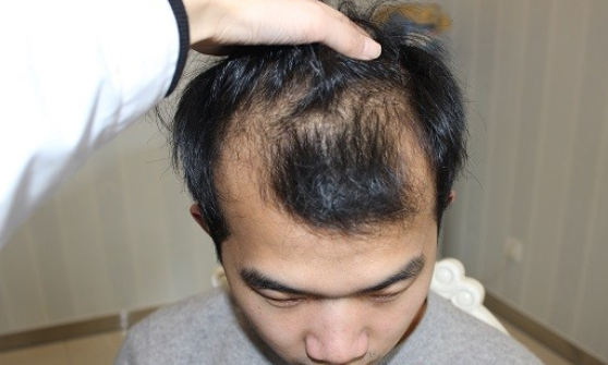 小伙在杭州大麦微针植了发，PUE2200额头+400PTT头顶加密