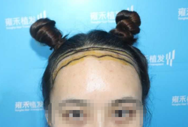 山西雍禾真实植发案例，前额发际线太高了勇敢来植发