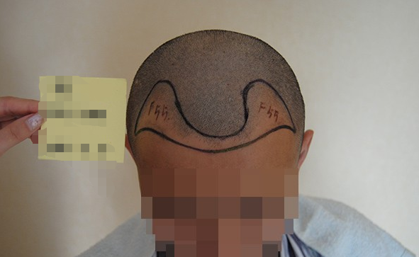 广州雍禾植发2200单位成功，抛掉了心中所有的不快乐