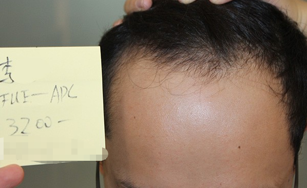 北京雍禾植发3200单位，额头变小了，发际线也出现了，我又变得帅气了