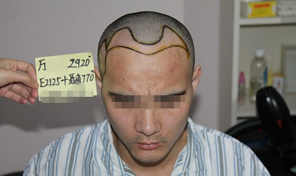 上海雍禾植发以后都说我变帅了，其实我想说感谢雍禾植发