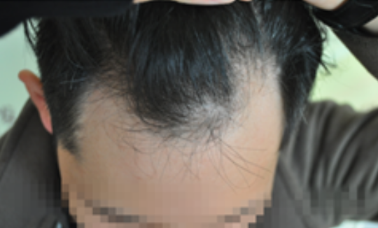 大麦微针勇哥植发记，植发后的效果两个字完美