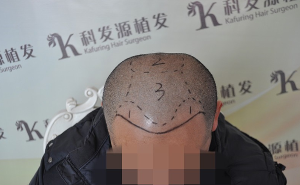 博士生在南京大麦微针植前额发际线2700单位，来看看前后对比效果