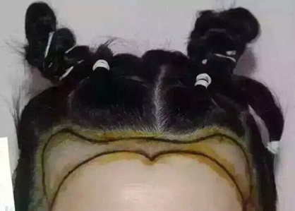 北京真实案例告诉你植发效果怎么样？看看一年后的效果