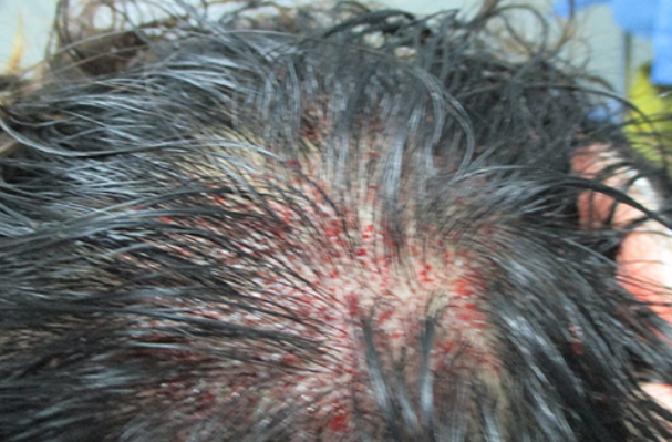 苏州植发医院，遗传性脱发采用FUE加密技术种植1100毛囊单位