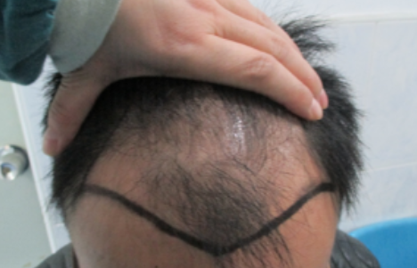 下定决心在上海做了植发，看看这一个月的恢复情况