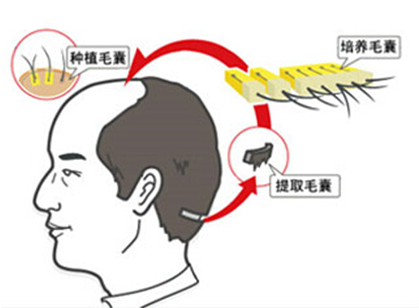 昆明植发一般要多少钱