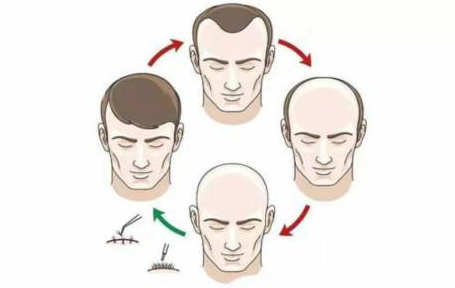 浙江的植发价格计算方式是什么?植发和头发加密一样吗