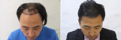 宁波植发手术需要花费多少钱?