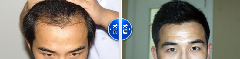 天津新发现发际线植发2000单位，看真实案例讲述植发后效果好不好