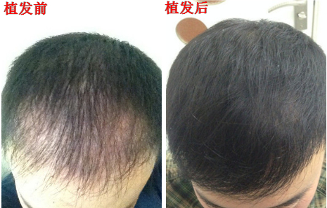发际线严重后移，选择植发来改变，看看在福州海峡植发3000单位效果怎么样