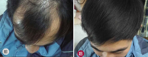广州新发现治疗脂溢性脱发患者，植发3000单位看看效果如何