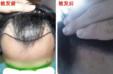 到郑州省育发植发研究院进行额角发际线植发手术，看看植发后恢复效果怎么样