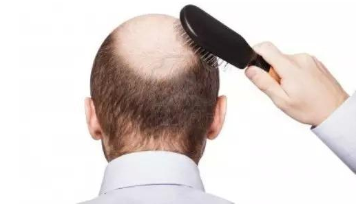 新疆乌鲁木齐植发贵不贵?植发多少钱呢?