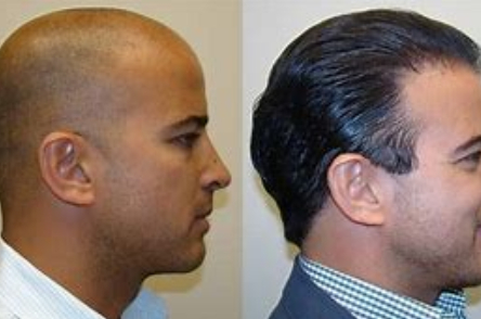 在无锡有名的植发医院植发,一般得多少钱?