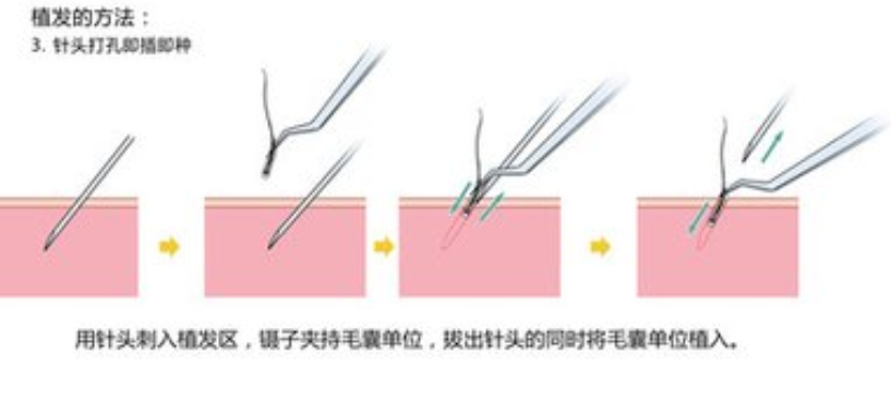 深圳植发大概得多少钱？