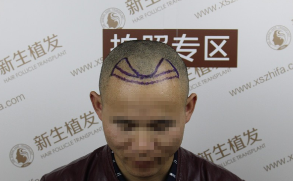 南京新生植发2000植发，手术一年前后效果怎么样？