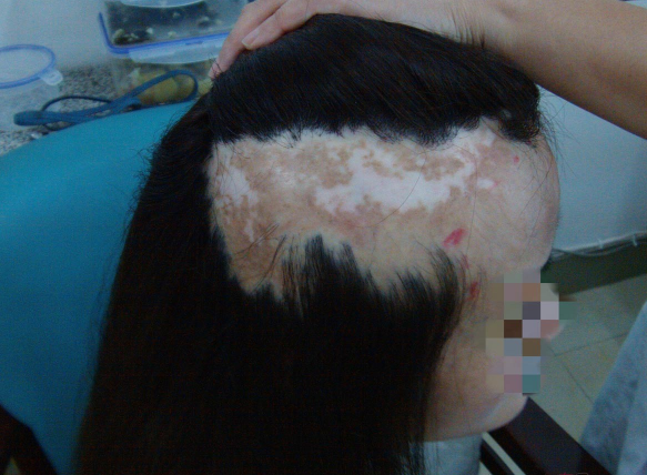 沈阳牛医生植发一年后，看看我的疤痕植发恢复效果