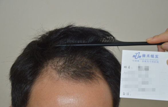 三级脱发在杭州进行植发手术，植发2000单位的术后感受