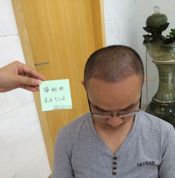在广州雍禾植发2500单位，让你们看看我植完发是什么样子的