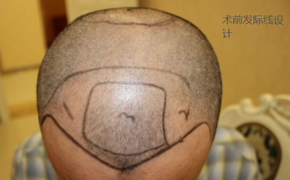 脱发四级，在济南大麦微针植发医院做了手术看看我的效果还有心理经历