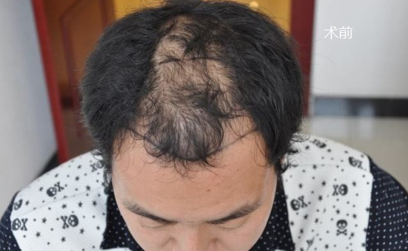 中美植发3100单位无痕植发，分享我的植发经历