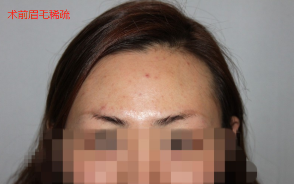 在广州新发现进行眉毛种植，术后效果让我惊喜