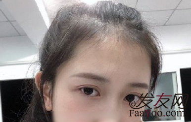 石家庄有什么好的公立医院，那么医院的植发效果好?(附植发案例)