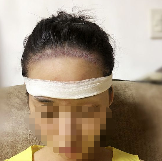 如何恢复高出天际的发际线？2000个毛囊发际线种植