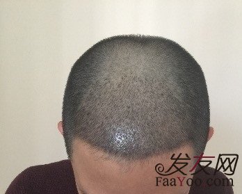 植发有没有什么危害和副作用？