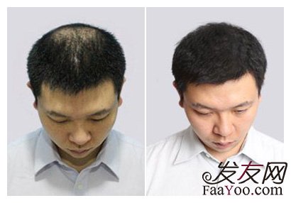 植发自己的毛囊不够怎么办？用别人的行不行？