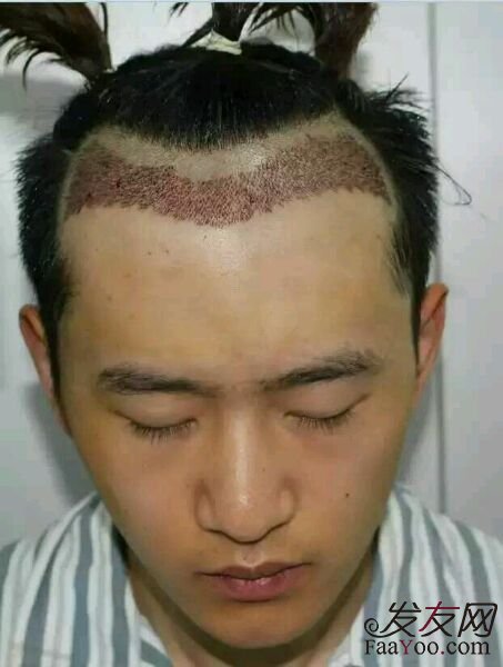 植发手术有后遗症吗？术后需要注意些什么？