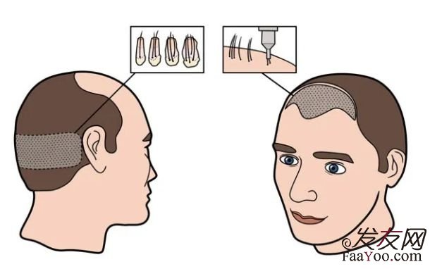 植发手术安全性怎么样？有风险吗？