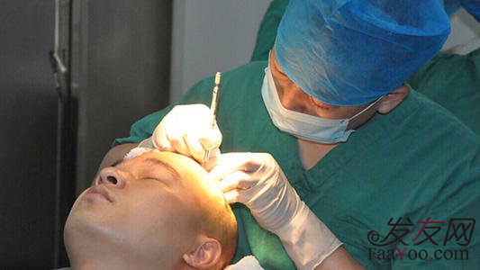 植发后的头发还会掉吗？效果可以维持多久？