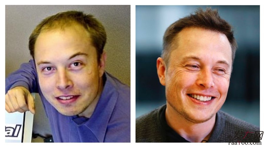 发际线种植到底有没有效果？附明星植发效果图