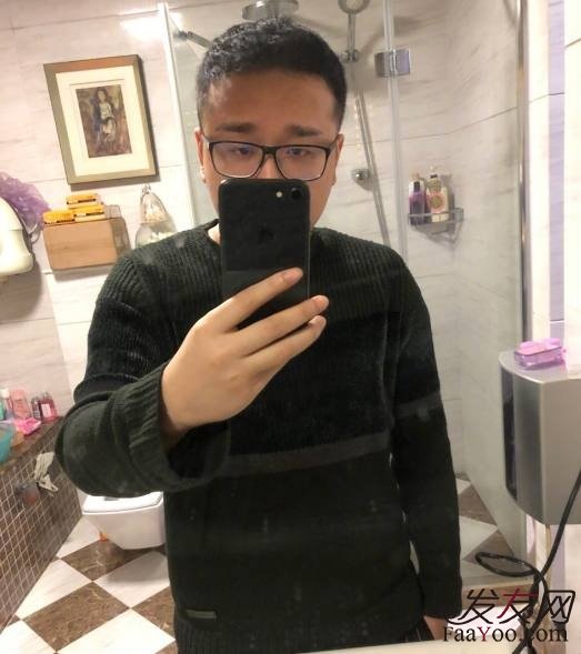 做过植发的网红（笑笑孙亚龙）现在效果怎么样了？