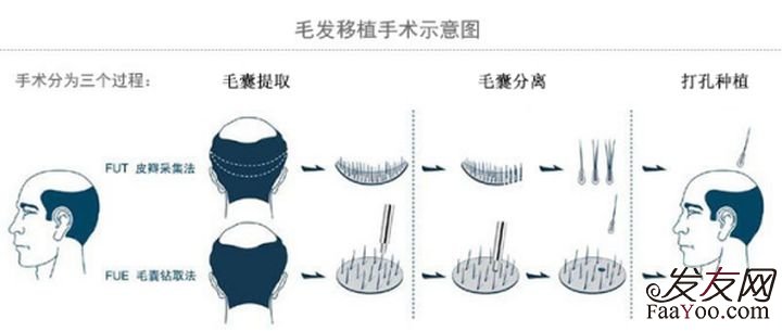 植发的技术都有哪些？该怎么选？