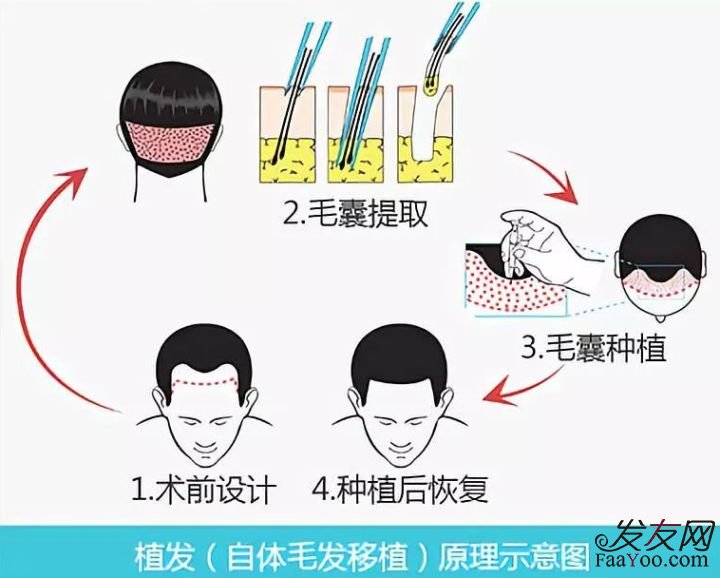 植发到底疼不疼？对身体有危害吗？
