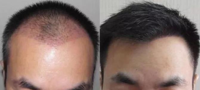 植发手术需要多久？植发术后效果恢复的自然吗？