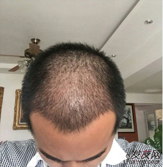 植发手术需要多长时间？需要请假休息吗？