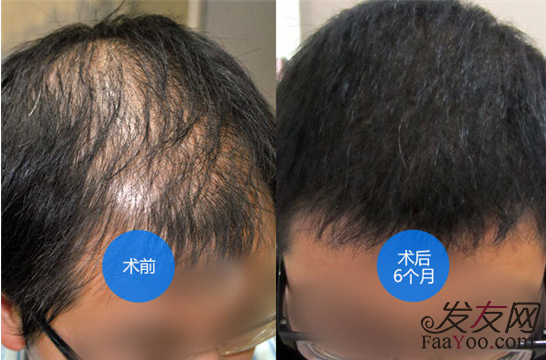上海新生植发怎么样？发际线种植、植眉大概需要多少钱？