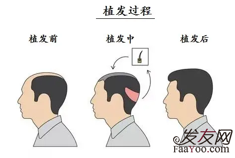 植发手术后枕部会不会变秃？ 可以使用别人的毛囊移植吗？