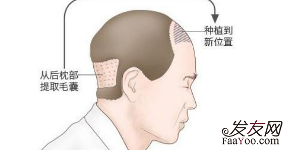 植发手术是不是“拆东墙补西墙”？后面会变秃吗？