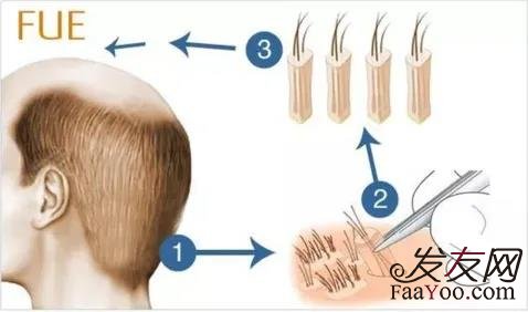 植发手术的过程是怎么样的？提取毛囊和种植同样重要？