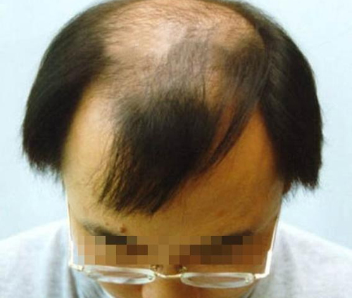 诱发遗传性脱发的因素有哪些图片效果2