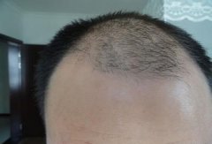 季节性脱发需治疗吗？
