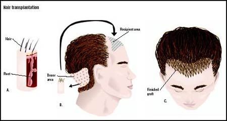 关于治疗男性脱发偏方文章图片1