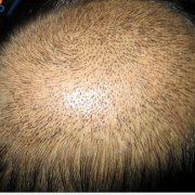造成中老年人脱发的原因有哪些？文章图片1