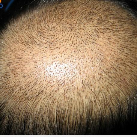 化学性脱发的症状有哪些外在表现文章图片1